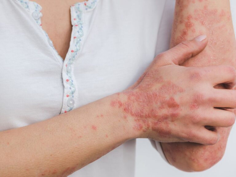 Artrite psoriasica e diagnosi precoce: come riconoscere i primi segnali e prevenire danni articolari